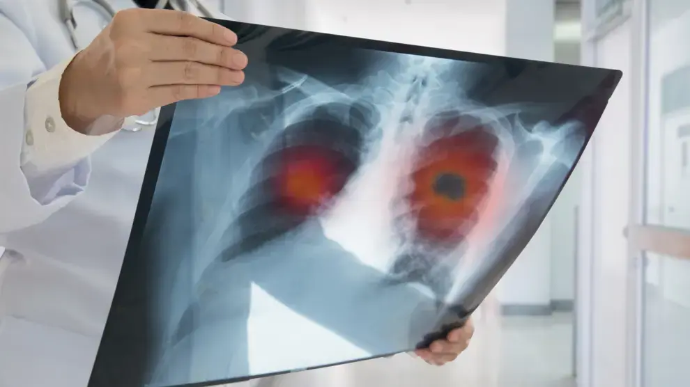 El síntoma temprano de un cáncer “asesino silencioso” que podría esconderse en tus heces